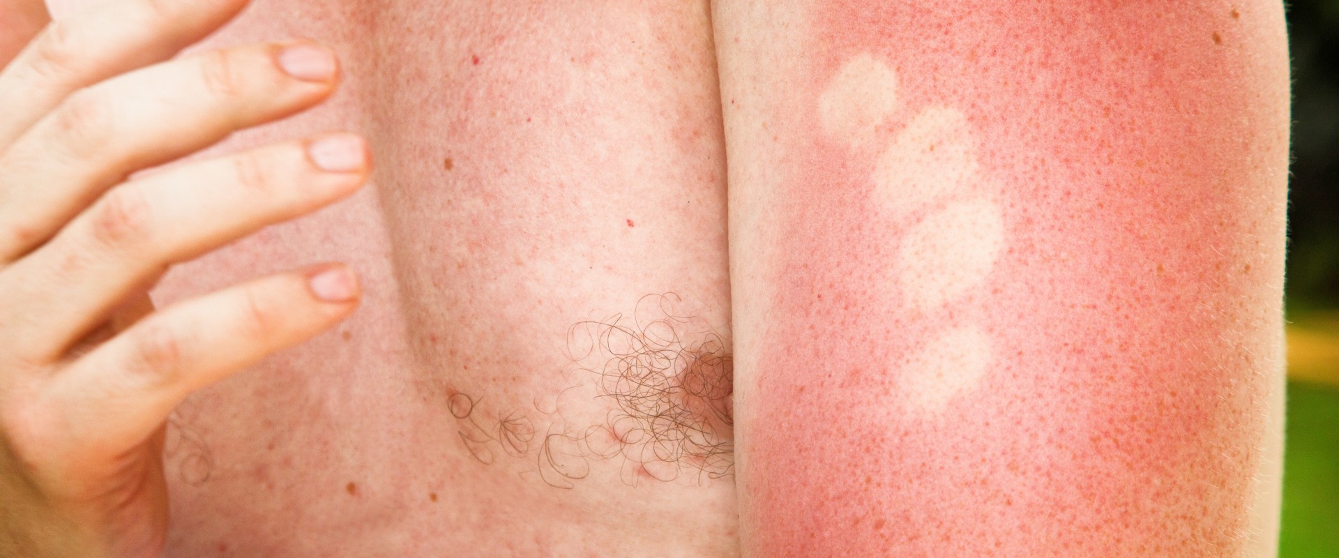 Understanding the Different Degrees of Sunburn