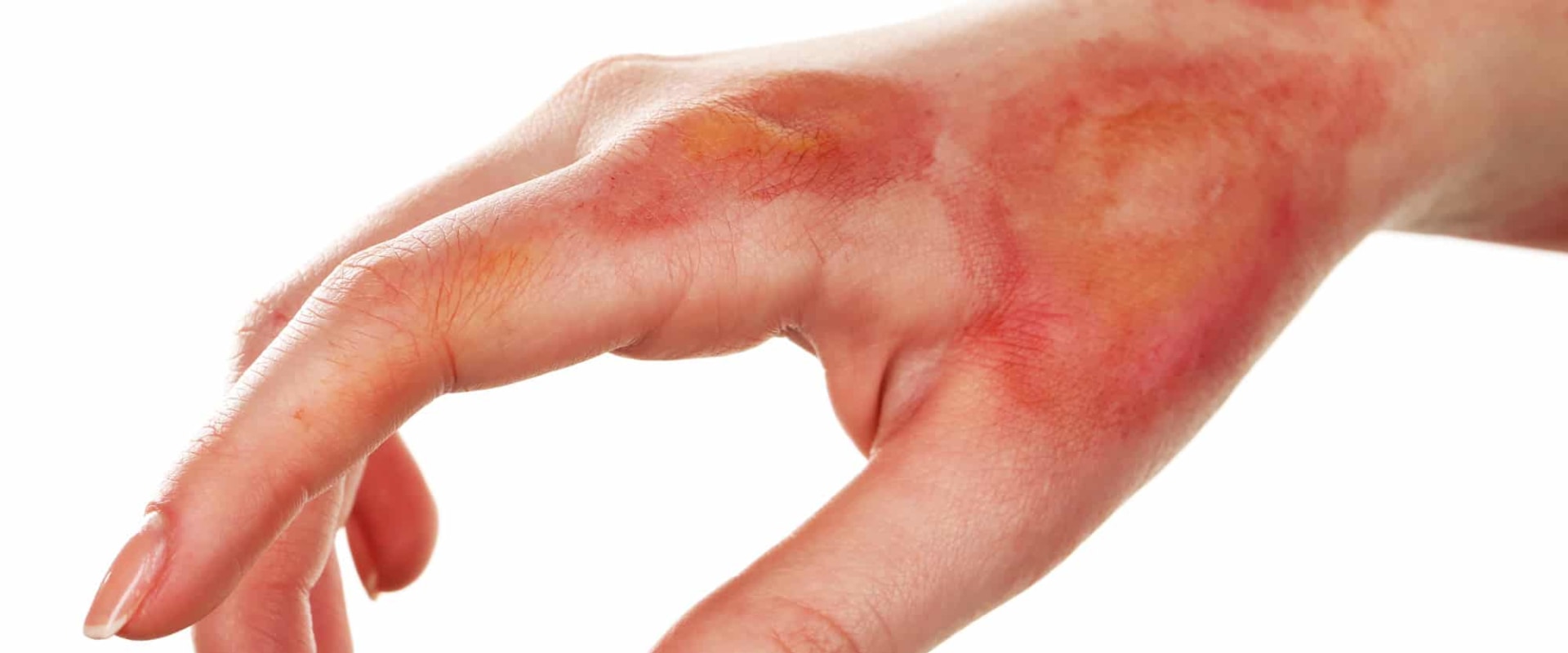 When is a Burn Considered a Medical Emergency?