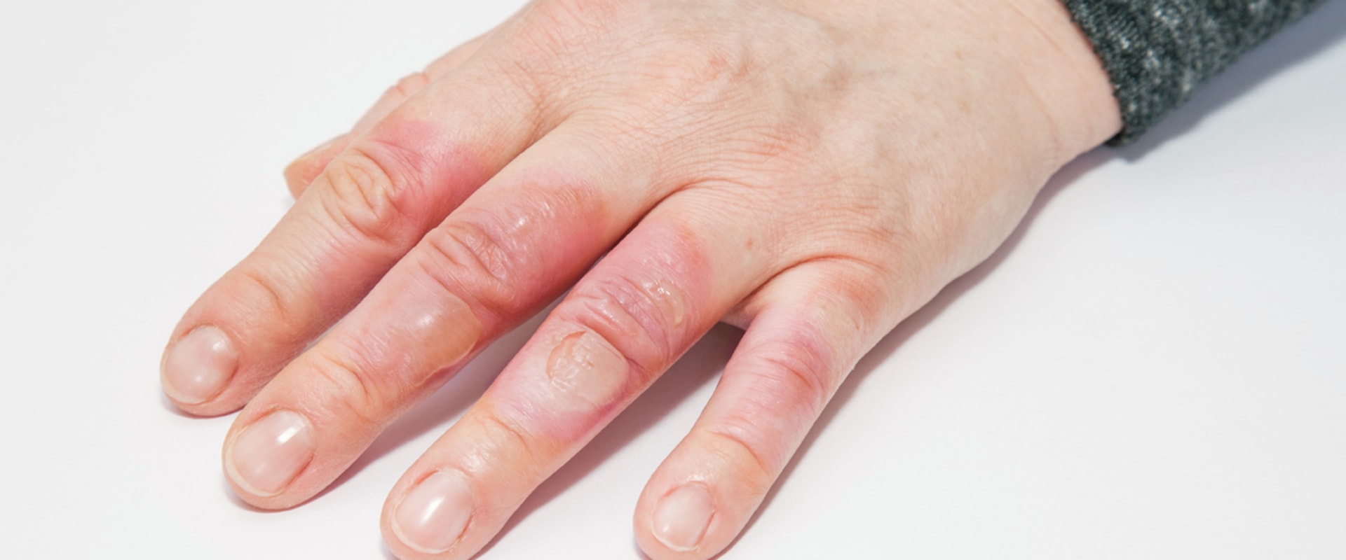 Expert Tips for Treating Second-Degree Burns at Home