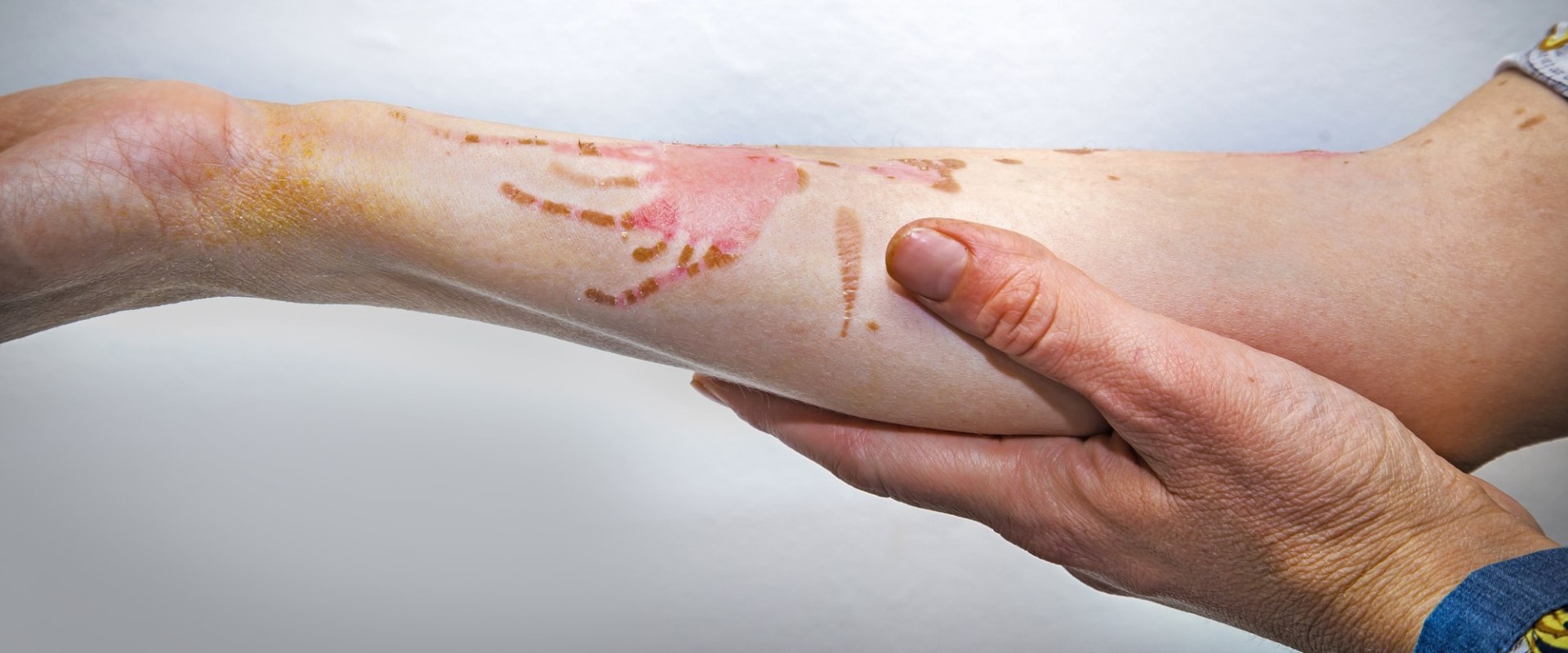 Understanding the Different Degrees of Burns