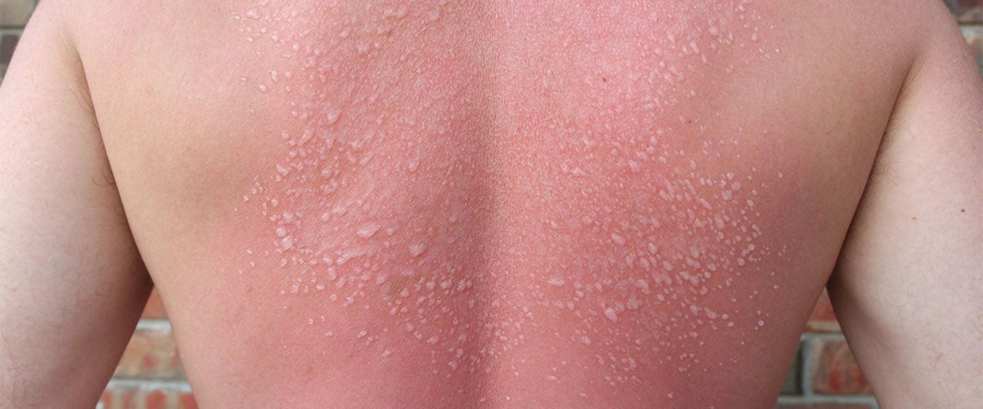 The Truth About Second-Degree Sunburns: Symptoms, Treatment, and Long-Term Effects