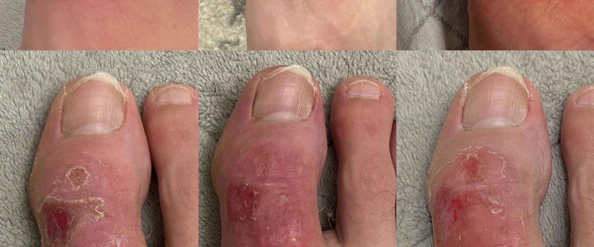 The Healing Process of Second-Degree Burns