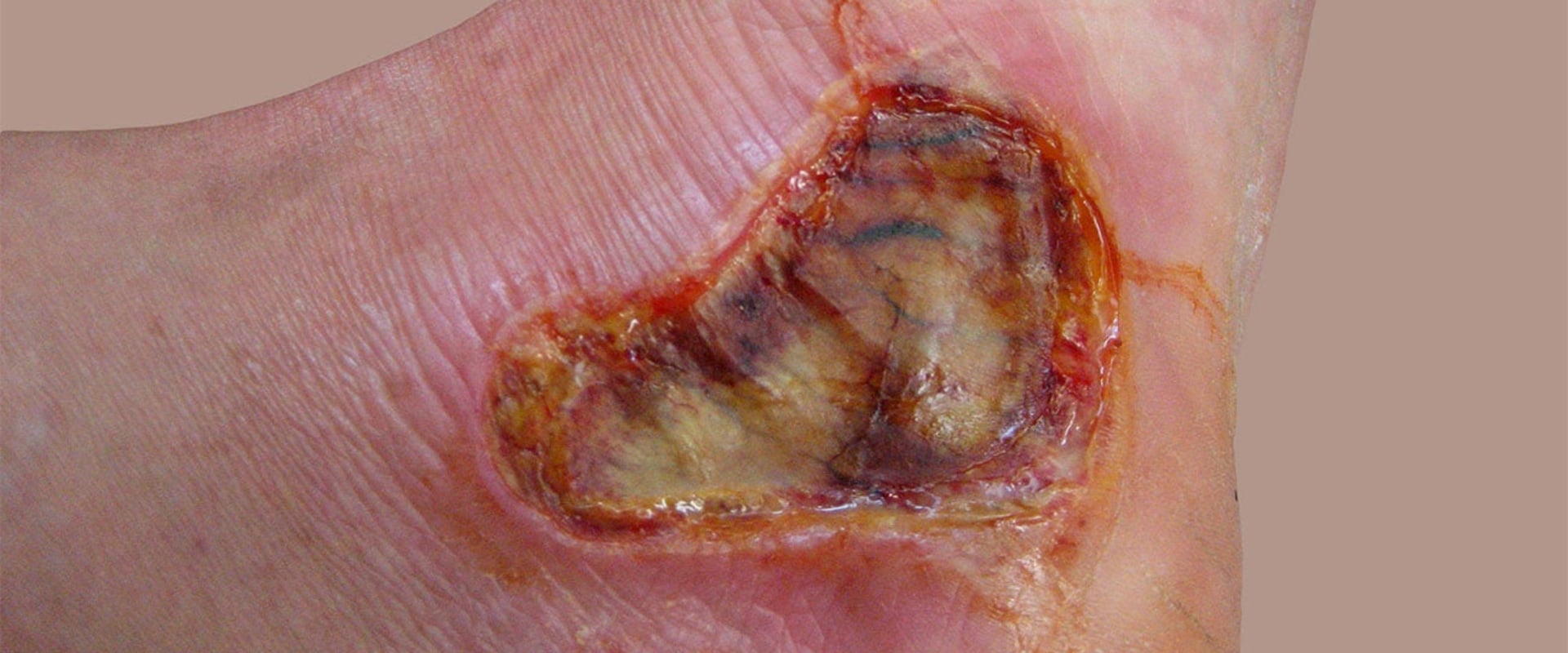 The Truth About First-Degree Burn Marks: Do They Really Go Away?