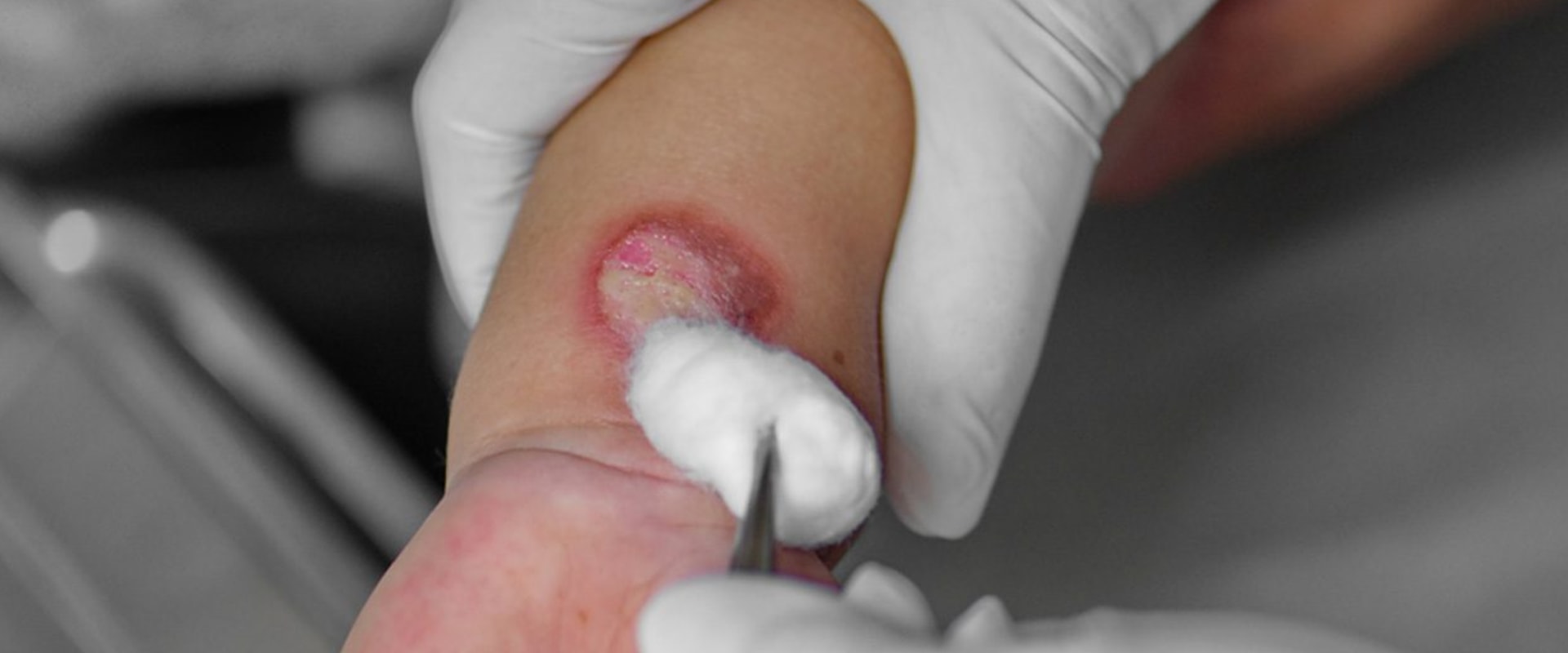 The Healing Journey of Second-Degree Burns: What to Expect and How to Care for Them