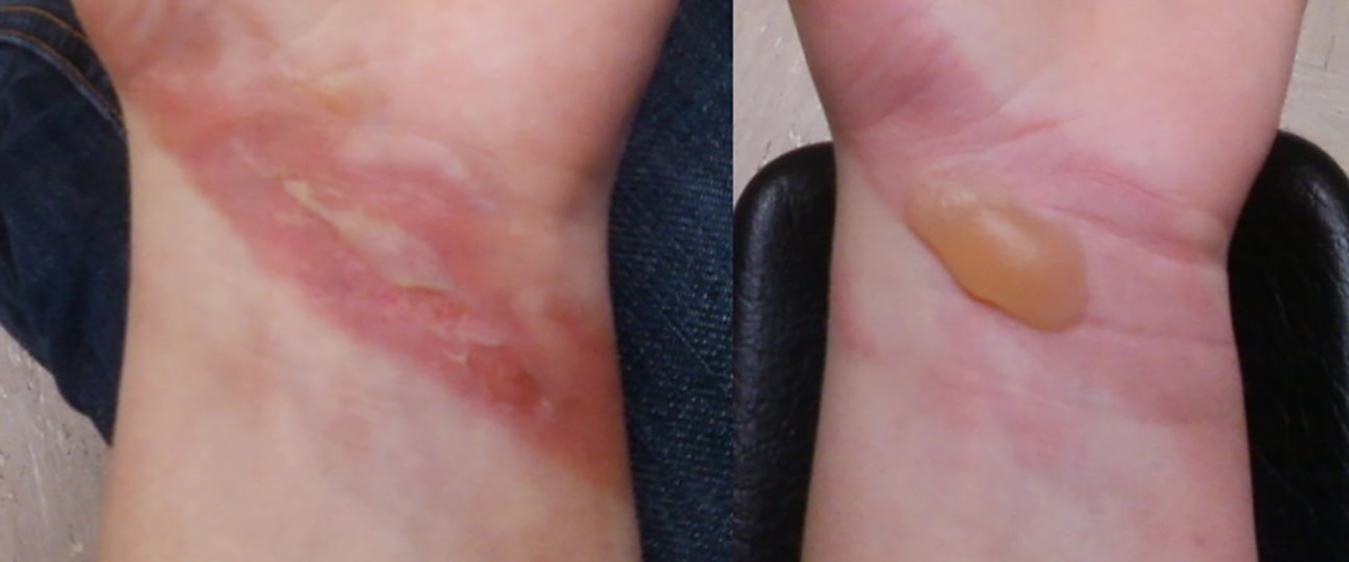 The Healing Process of Second-Degree Burns