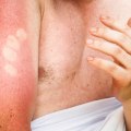 Understanding the Different Degrees of Sunburn