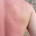 The Truth About Second-Degree Sunburns: Symptoms, Treatment, and Long-Term Effects