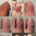 The Healing Process of Second-Degree Burns