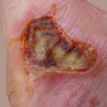 The Healing Process of First-Degree Burns