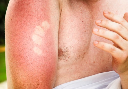 Understanding the Different Degrees of Sunburn