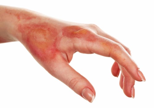 When is a Burn Considered a Medical Emergency?