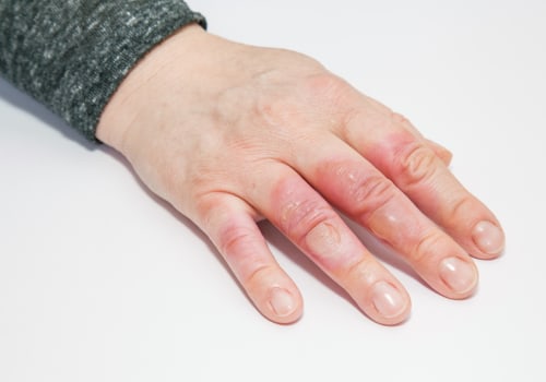 Expert Tips for Treating Second-Degree Burns at Home