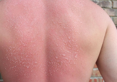 The Truth About Second-Degree Sunburns: Symptoms, Treatment, and Long-Term Effects