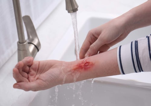 When to Seek Emergency Care for a Burn