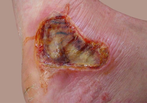 The Healing Process of First-Degree Burns