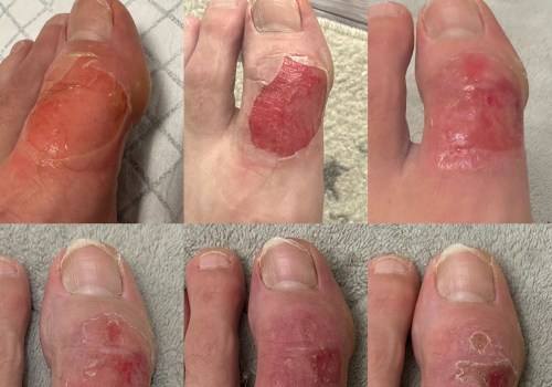 The Healing Process of Second-Degree Burns